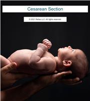 Cesarean Section: A Review