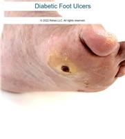 Diabetic Foot Ulcers