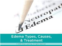 Managing Edema