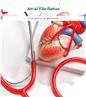 Atrial Fibrillation